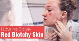 Blotchy Skin
