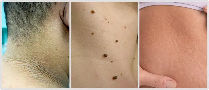 Skin Conditions